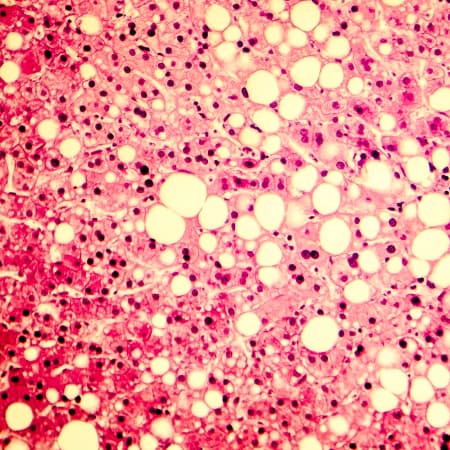 Nonalcoholic Steatohepatitis: The Primary Care Perspective
