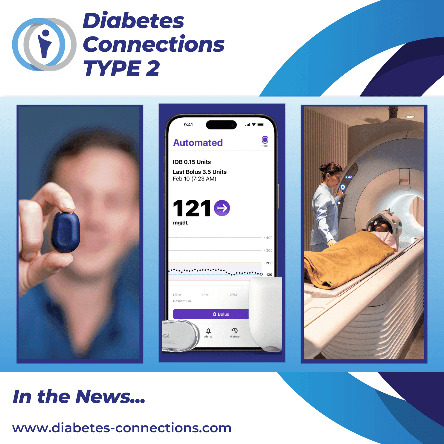 In the News... Omnipod 5 iPhone update, Libre & Dexcom news, overnight insulin pump and more!