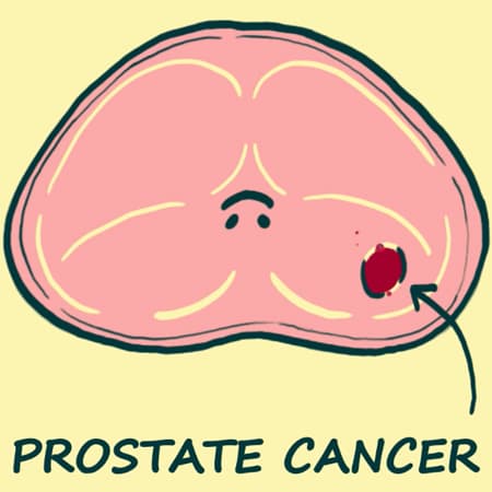 Update: New Recommendations for Prostate Cancer Screening
