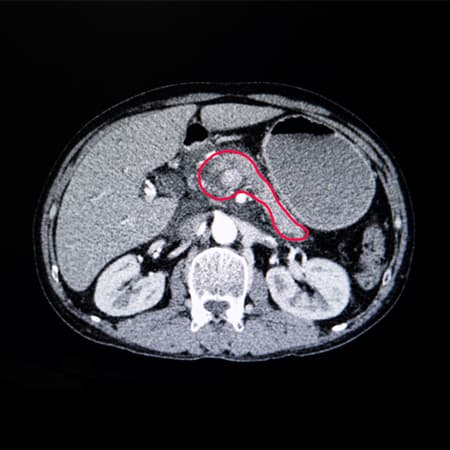 Pancreatic Cancer
