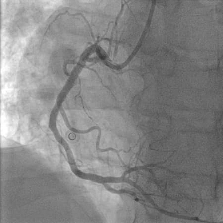 Percutaneous Coronary Intervention (PCI) For Stable Coronary Artery Disease - Reducing Inappropriate Use