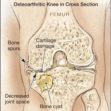 Osteoarthritis—Diagnosis and Treatment