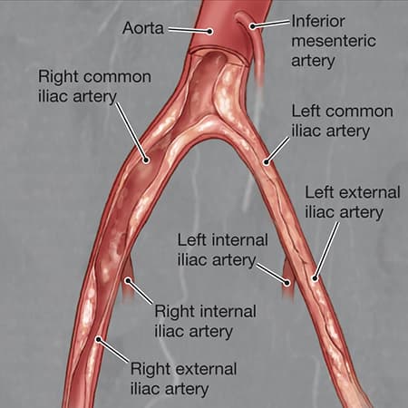 Lower Extremity Peripheral Artery Disease Without Chronic Limb-Threatening Ischemia