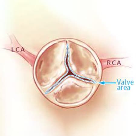 Changes in Functional Status in the Year After Aortic Valve Replacement