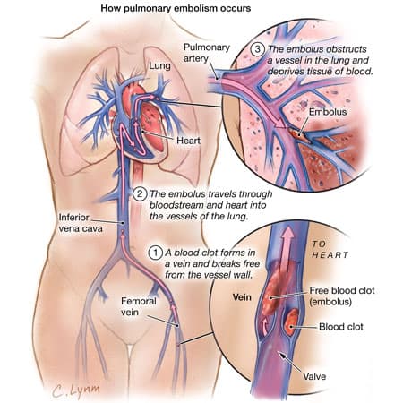 Prevalence of Pulmonary Embolism in Patients With Syncope